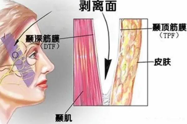 拉皮手术的疤痕多久消失 拉皮手术是全麻还是局麻