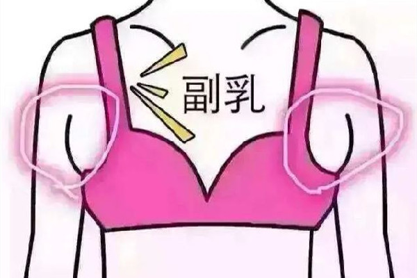 副乳切除手术会有疤痕吗 副乳切除手术怎么才能看不到疤痕